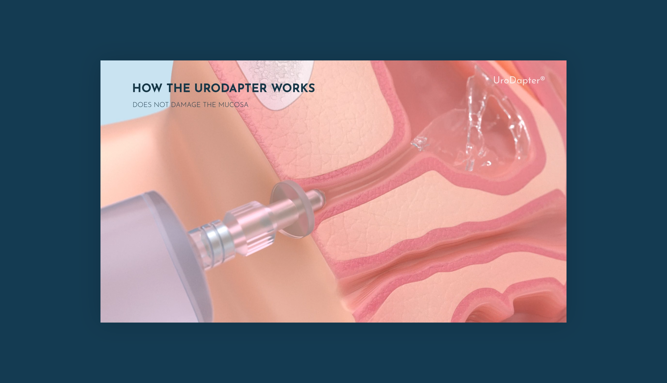 Simplifying Urological Care with UroDapter