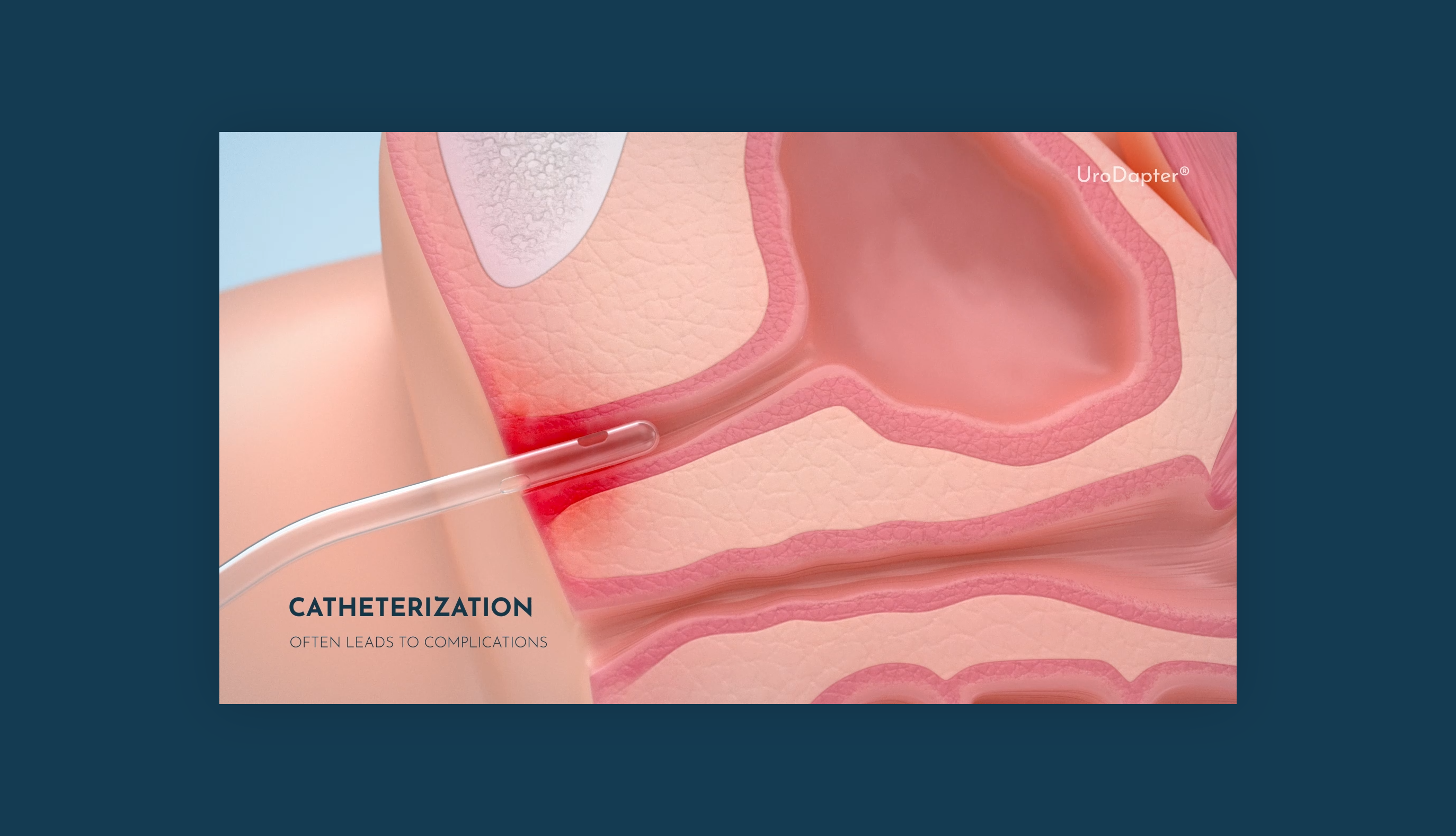 Simplifying Urological Care with UroDapter
